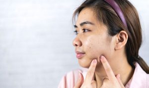 Penyebab dan Solusi Jerawat Batu di Wajah