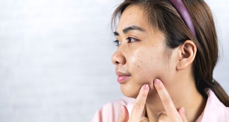 Penyebab dan Solusi Jerawat Batu di Wajah