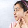 Penyebab dan Solusi Jerawat Batu di Wajah