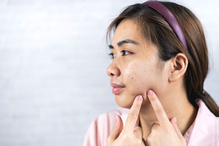 Penyebab dan Solusi Jerawat Batu di Wajah