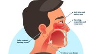 Rhinitis Alergi Dingin