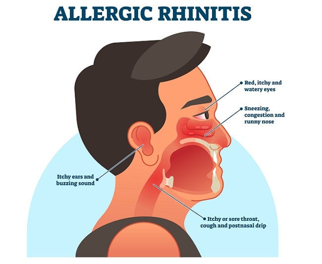 Rhinitis Alergi Dingin
