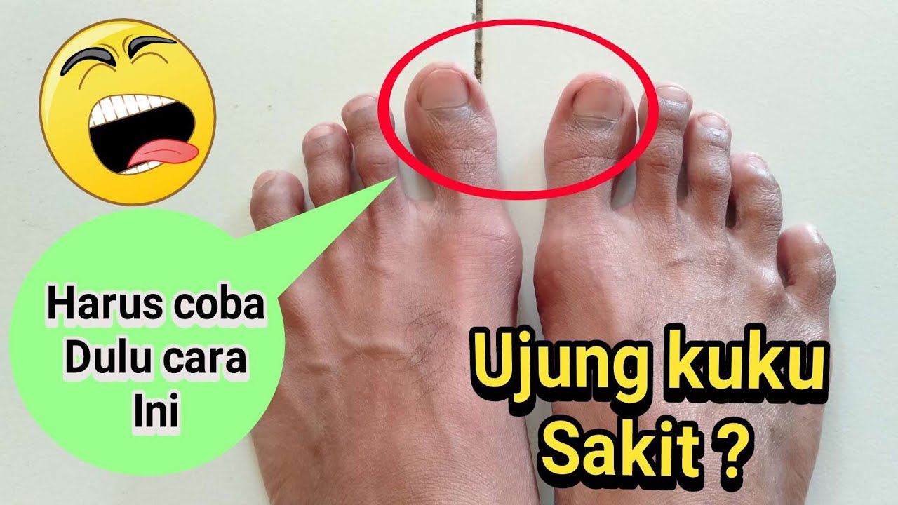 Kuku Jempol Kaki Rusak
