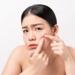 Tips Ampuh Atasi Jerawat untuk Kulit Sehat