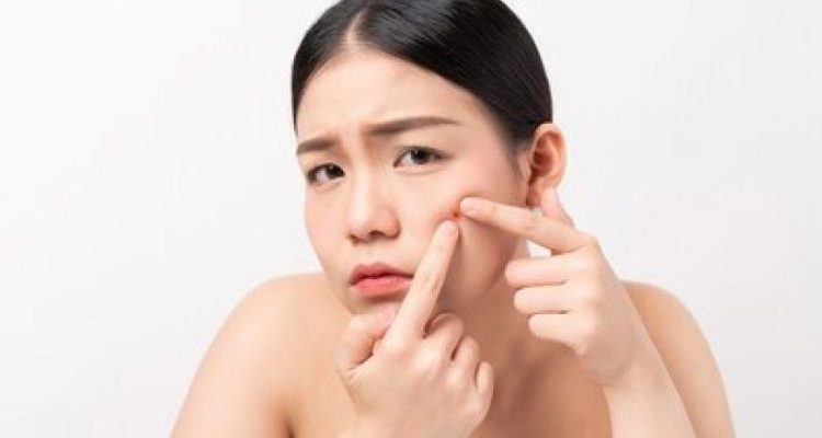Tips Ampuh Atasi Jerawat untuk Kulit Sehat