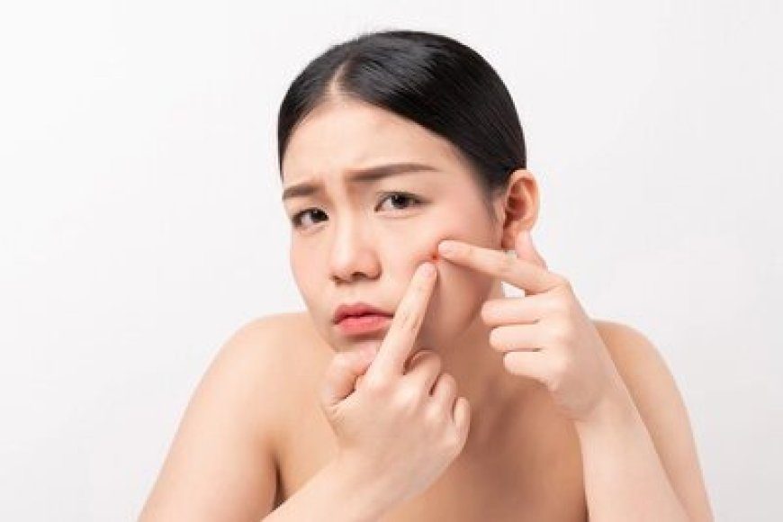 Tips Ampuh Atasi Jerawat untuk Kulit Sehat